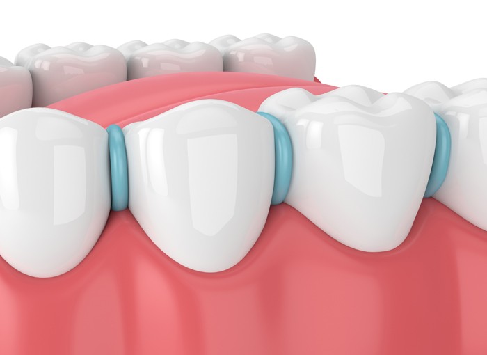 What are dental spacers for adults?