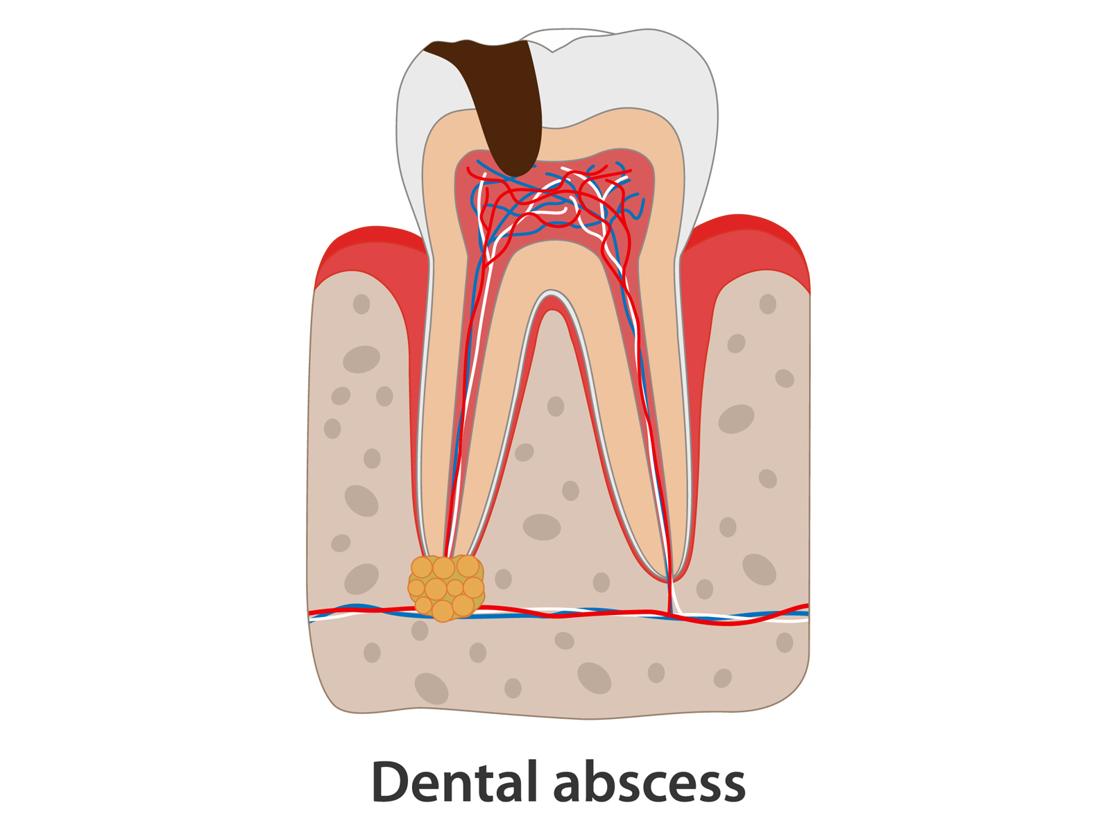 How do I know if my tooth abscess is spreading?
