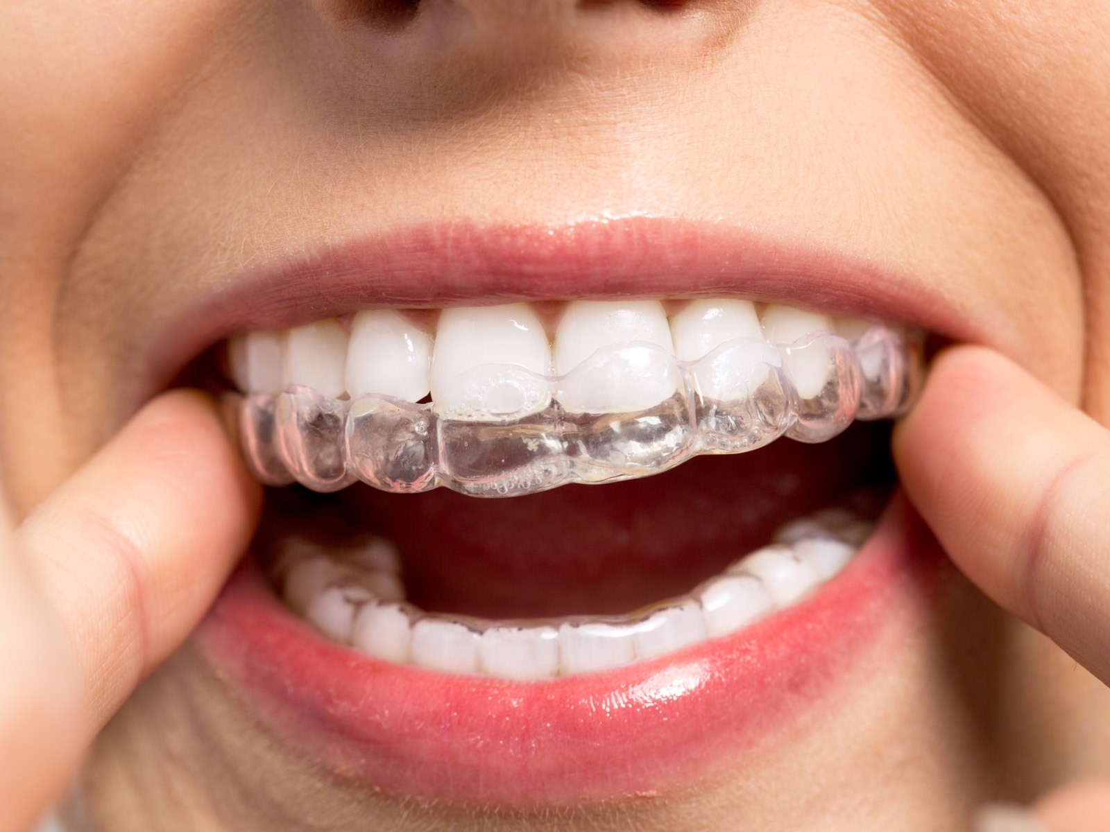 How long do your teeth hurt after getting Invisalign?