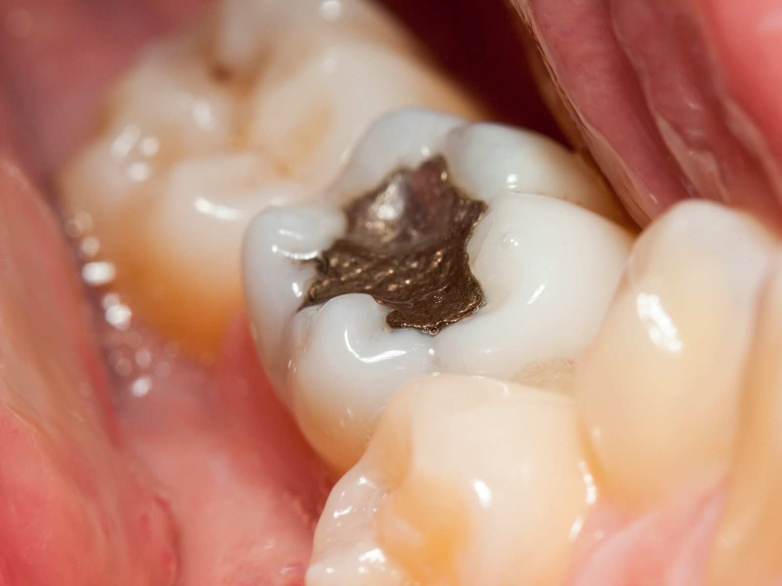 What should you know about dental health and tooth fillings?