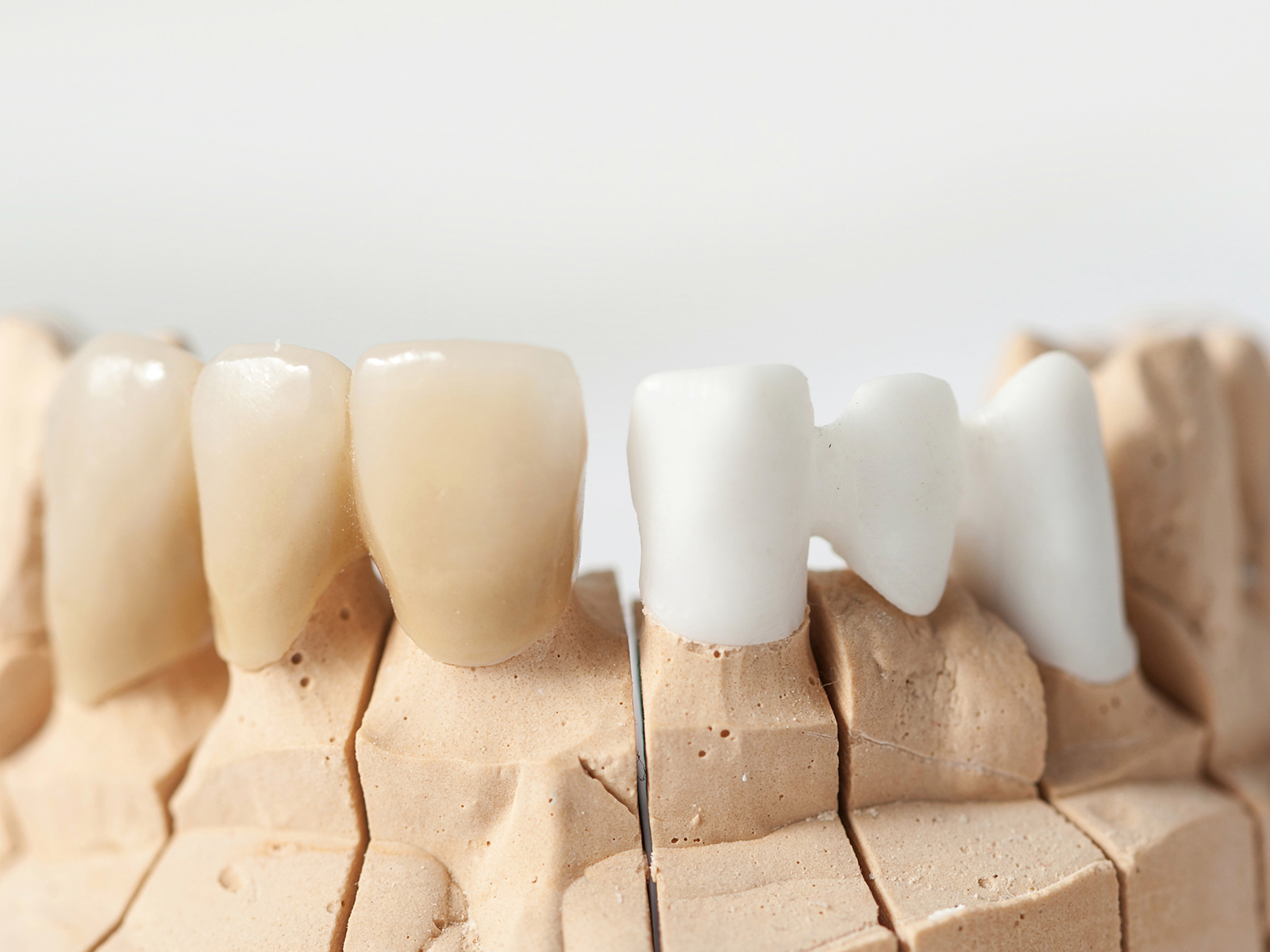 How Can Dental Bridges Help In Oral Health Restoration?
