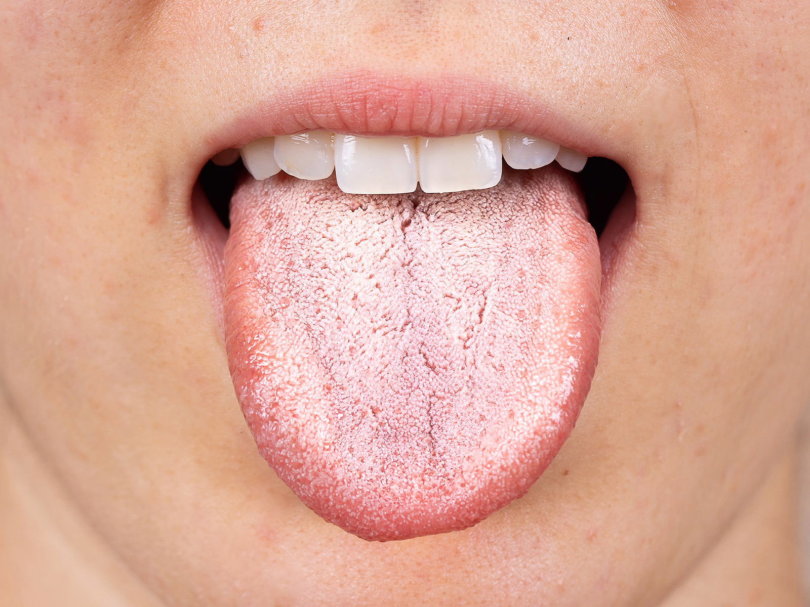 How long does oral thrush last without treatment deals