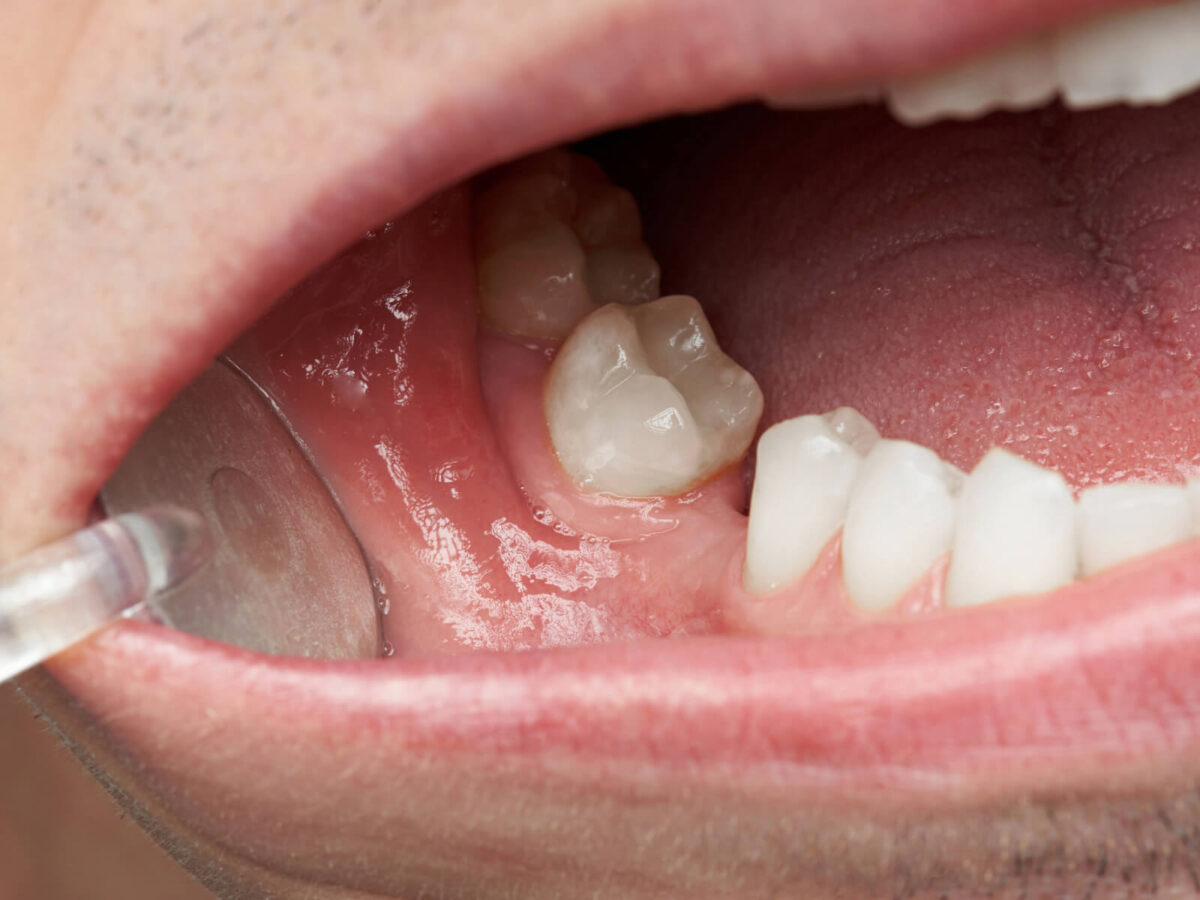 Why Dentures Are a Great Solution for Missing Teeth