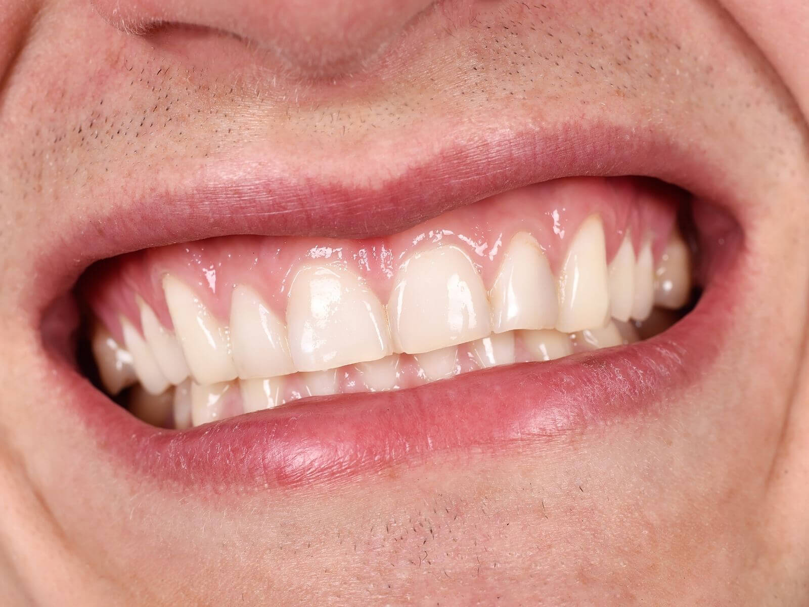 Gum Disease Warning Signs You Shouldn’t Ignore