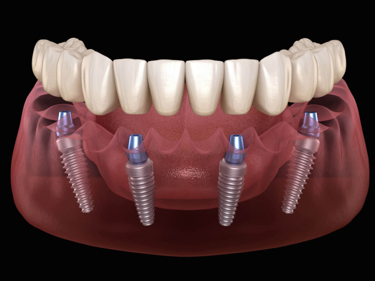 Dental Implants 101: What You Need To Know Before Getting One