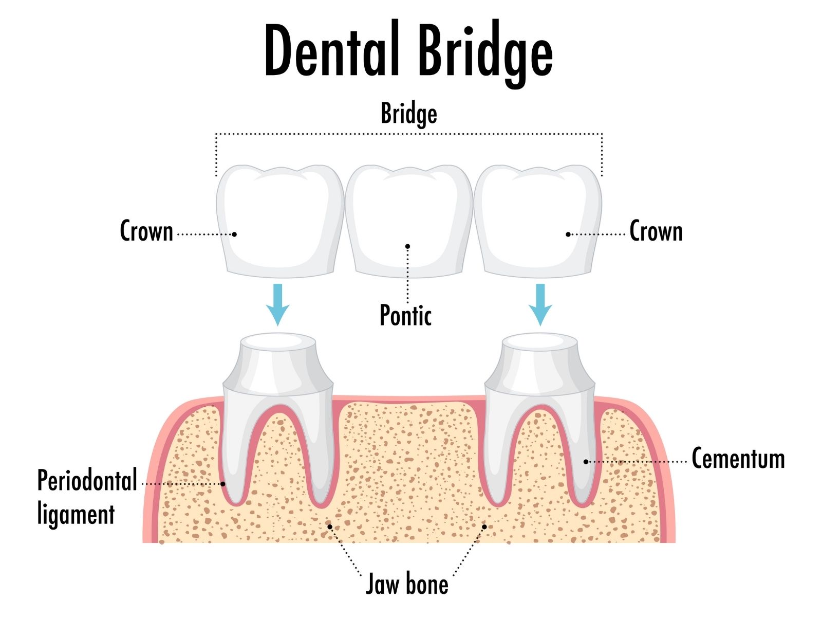 Comparing Dental Crown Types: Which Material Works Best?