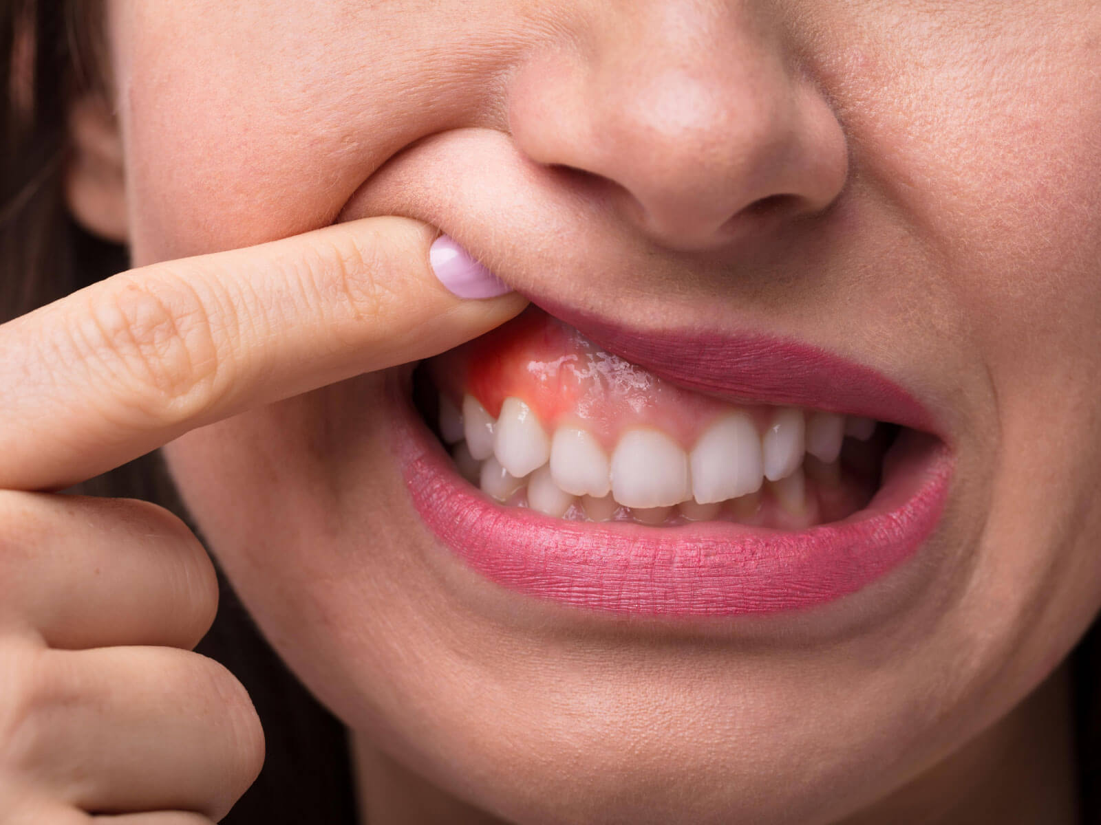 Swollen Gums: Causes, Symptoms, and Treatment Options