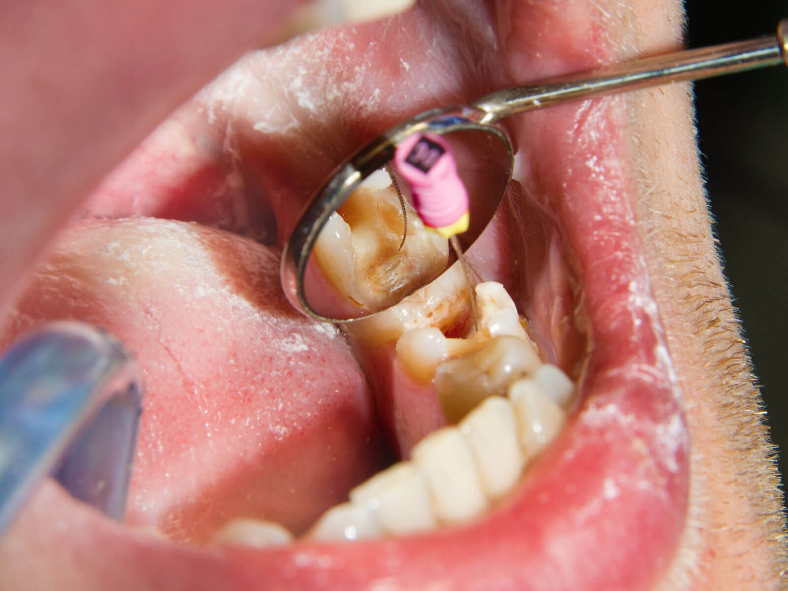 What Is Dental Calculus (Tartar)? Causes & Removal
